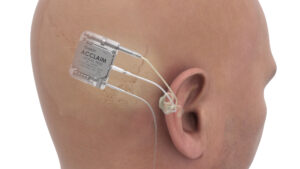 Example of placing an internal cochlear implant behind the ear.